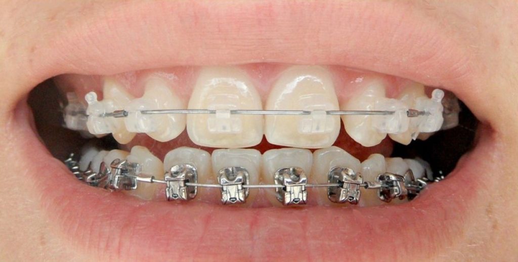 Les Différents Types de Traitements Dentaires et Leurs Avantages