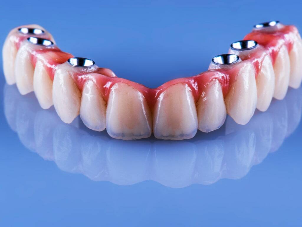 La Pose d'Implants Dentaires